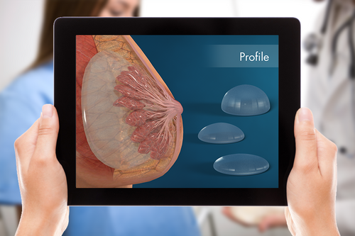 Breast Implant Options animation the latest addition to Plastic Surgery Library