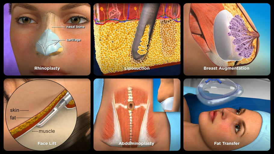 Updated HD Laser Hair Removal Animation Now Available in Spanish and Portuguese